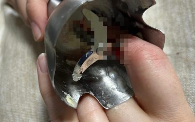 O femeie și-a introdus un deget în blender, iar o alta a suferit arsuri grave după o cădere peste aragaz, ambele fiind transportate la spital în Iași